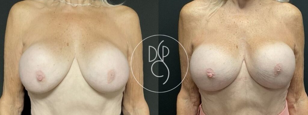 DCPS Breast Implant Revision